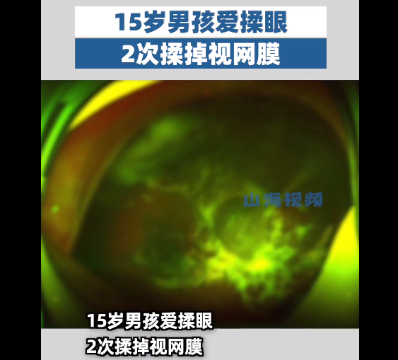 男孩喜欢揉眼睛，结果2次揉掉视网膜（2023男孩2次揉掉视网膜）